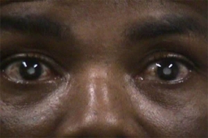 C&ocirc;te d'Ivoire-Sant&eacute;: On cherche 500 malades de la cataracte pour les op&eacute;rer gratuitement