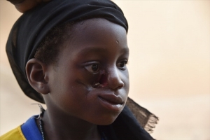 Sant&eacute;: Le noma, &eacute;pouvantable maladie de la mis&egrave;re et de la malnutrition