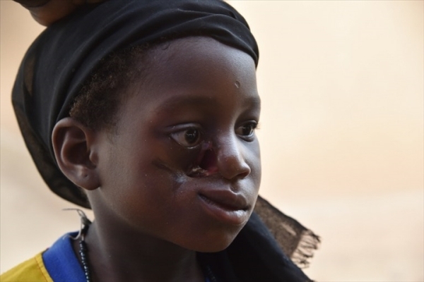 Sant&eacute;: Le noma, &eacute;pouvantable maladie de la mis&egrave;re et de la malnutrition