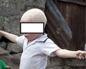 Un enfant albinos (image d'archive &agrave; titre d'ullustration, DR)
