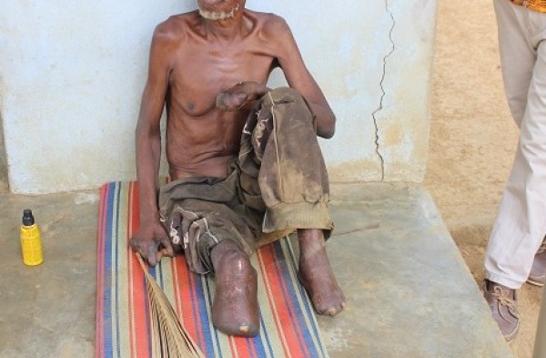 C&ocirc;te d&rsquo;Ivoire : Une vingtaine de nouveaux cas de l&egrave;pre d&eacute;tect&eacute;s &agrave; Dimbokro