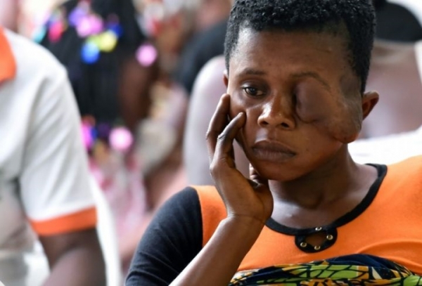 C&ocirc;te d&rsquo;Ivoire: rendre le sourire aux victimes du noma, maladie qui d&eacute;figure et exclut