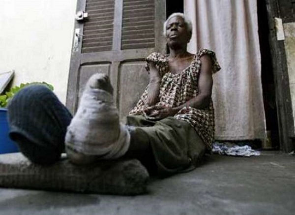 Une personne vivant avec la l&egrave;pre en C&ocirc;te d'Ivoire