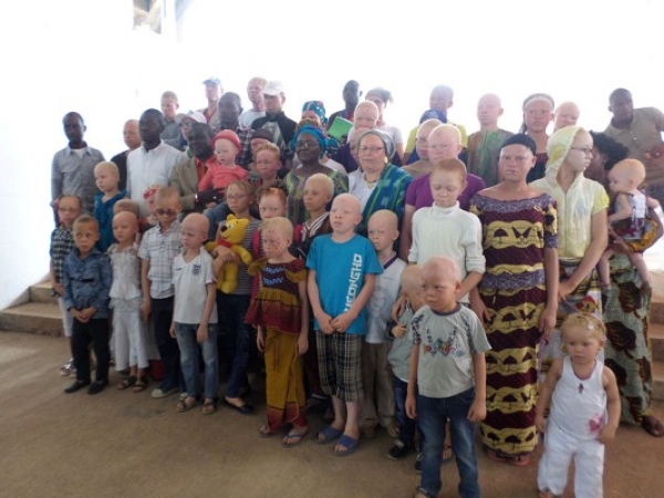 Les albinos de C&ocirc;te d&rsquo;Ivoire sollicitent de l&rsquo;aide pour leurs probl&egrave;mes de peau